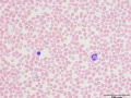 Toxic heterophil and lymphocyte