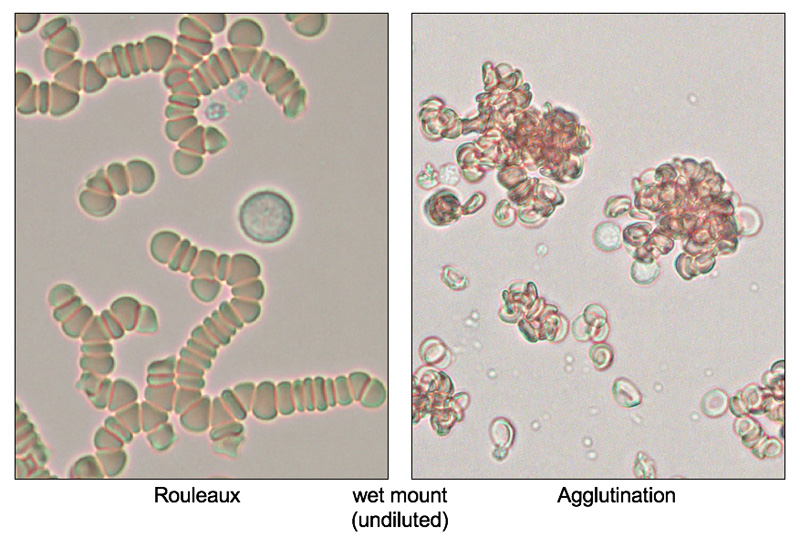 Agglutination vs rouleaux