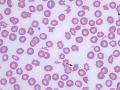 Acanthocytes & schistocytes (dog)