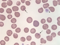 Howell-jolly bodies