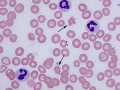 Acanthocyte