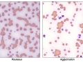 Agglutination vs rouleaux