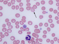 Siderocyte