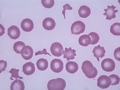 Schistocytes & acanthocyte (dog)
