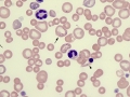 Siderocytes & spherocytes (dog)