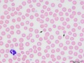 Spherocyte-like fragment