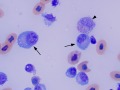 Lymphoid leukemia