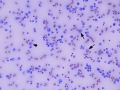 Lymphoid leukemia