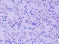 Lymphoid leukemia