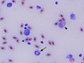 Lymphoid leukemia