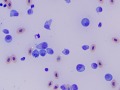 Lymphoid leukemia