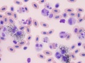 Melanomacrophage