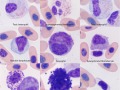 Compilation (prehensile with inflammation)