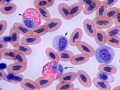 Toxic immature heterophil & monocyte