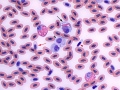 Toxic immature heterophil & monocyte