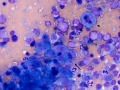 Hemangiosarcoma