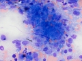 Hemangiosarcoma