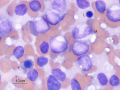 Lymphoma of granular lymphocytes (dog)