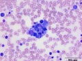 Aggregate of histiocytes