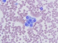 Chemodectoma