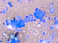 Chemodectoma