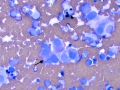Chemodectoma