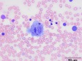 Histiocytic sarcoma (aberrant mitoses)