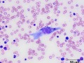 Histiocytic sarcoma (aberrant mitoses)