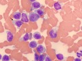 Leukemia of granular lymphocytes