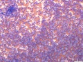 Leukemia of granular lymphocytes