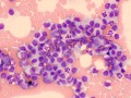 Leukemia of granular lymphocytes