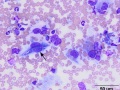 Histiocytic sarcoma