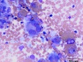 Histiocytic sarcoma