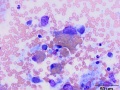 Histiocytic sarcoma