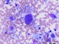 Histiocytic sarcoma