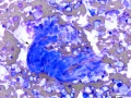 Histiocytic sarcoma (cat; vascular profile)