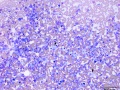 Histiocytic sarcoma (cat)
