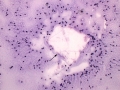 Cholesterol crystals (mediastinum)