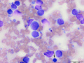 Granular lymphoma (mediastinum)