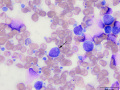 Granular lymphoma (mediastinum)