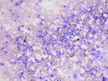 Granular lymphoma (mediastinum)