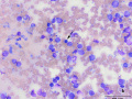 Granular lymphoma (mediastinum)
