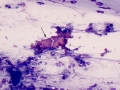 Flame figures (lung)