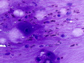 Chondroid-producing tumor (lung, DQ)