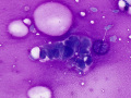 Chondroid-producing tumor (lung)