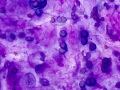 Chondroid-producing tumor (lung)