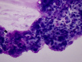 Chondroid-producing tumor (lung)