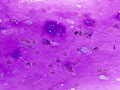 Chondroid-producing tumor (lung)