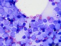 Acute myeloid leukemia