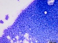 Acute myeloid leukemia